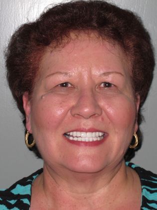 After smile makeover