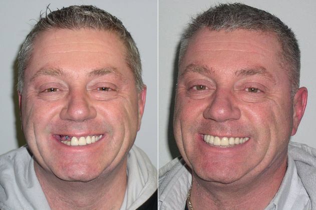 Before and after photos of a man with dental implants