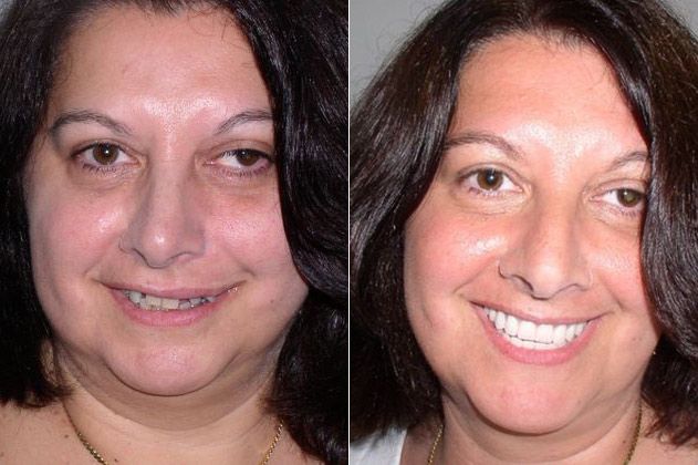 Before and after photos of a woman with dental implants