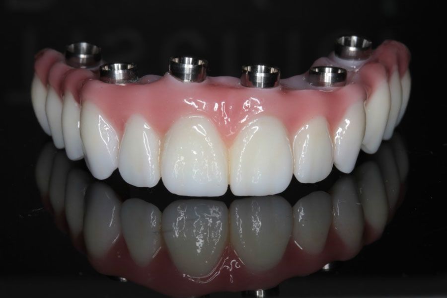 teeth tomorrow, implant-supported dental bridge